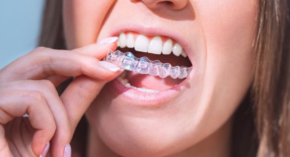 Close-up of a woman inserting a clear aligner or invisible braces over her teeth, showing a dental orthodontic treatment