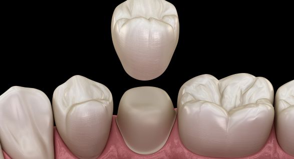 3D digital illustration of a dental crown being placed over a prepared tooth, showcasing the same-day crown procedure